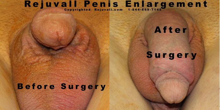 Penis Enlargement Before After Photos -03