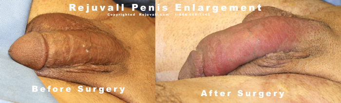 Penis Enlargement Photos 07b