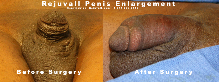 Penis Enlargement Surgery Photos Before After -04