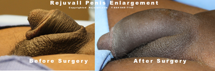 Penis Enlargement Surgery Before After Photos 06a