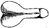 hypospadias